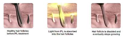 You will need to undergo at least six to eight treatment sessions at home, each with an interval of four to six weeks. Ipl Hair Removal Products Simple And Effective Hair Removal