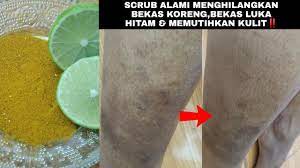 Bawang merah dibelah dan dikisar secukupnya. Bagaimana Untuk Menghilangkan Bekas Luka Gatal Parut 2021