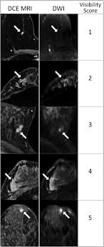 According to breastcancer.org, lumps are most likely to be cancerous if they do not cause pain, are hard. Visibility Of Mammographically Occult Breast Cancer On Diffusion Weighted Mri Versus Ultrasound Clinical Imaging