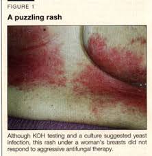 Image result for Intertrigo under breasts