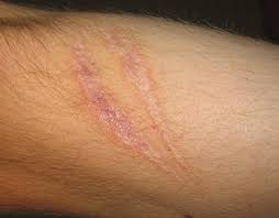 Can you identify these skin diseases? Scar Wikipedia