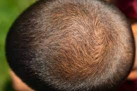 Is There Really A Hat That Grows Hair Laser Cap Facts 2021 Guide