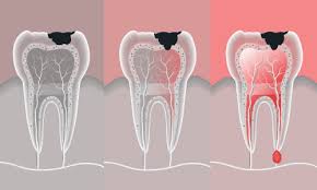 Although it may not be a cheap dental crown this type of treatment shouldn't be ignored. Root Canal Cost In Houston Omega Dental Houston Tx