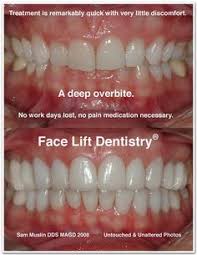 Overbite and underbite correction without surgery. 7 Best Overbite Correction Ideas Overbite Correction Face Lift Dentistry Dentistry