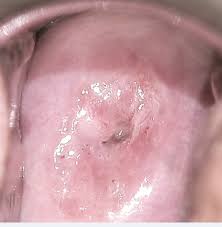 Image result for Colposcopy