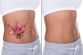 Is It Normal To Blister After Laser Tattoo Removal