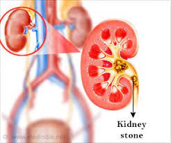 Alport Syndrome Latest News And Research Updates