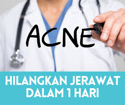 Kalau rajin nak apply 1 muka pon boleh. 3 Cara Nak Hilangkan Jerawat Dalam Masa 1 Hari 2021 Sihat Me