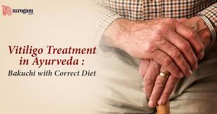 Vitiligo Treatment In Ayurveda Ayurvedic Home Remedies