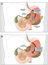 There are 100+ professionals named krijn van, who use linkedin to exchange information, ideas, and opportunities. Transluminal Endoscopic Step Up Approach Versus Minimally Invasive Surgical Step Up Approach In Patients With Infected Necrotising Pancreatitis Tension Trial Design And Rationale Of A Randomised Controlled Multicenter Trial Isrctn09186711