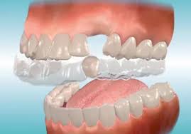 Replacing Missing Teeth Saskatoon SK | Replace Tooth