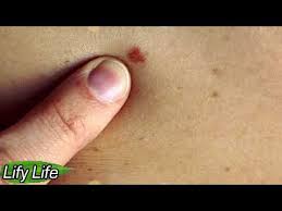 Read more about blood cancer These 6 Signs Of Blood Cancer Should Be Known To Each Of Us Youtube