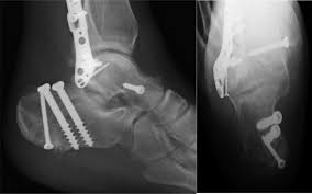 Image result for Calcaneus Compression Fracture