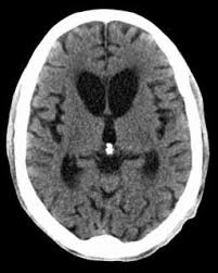 Huntington Disease Neurology Medbullets Step 1
