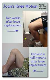 Knee Motion Key To Success Of Knee Replacement Surgery Knee Replacement Exercises Knee Replacement Knee Replacement Surgery