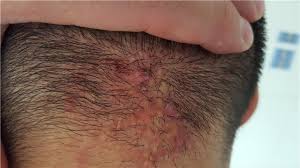 De cele mai multe ori, durerea de cap este un semnal de alarma pe care organismul il transmite atunci cand se confrunta cu. Tratamente Si Sfaturi Cosuri Pe Pielea Capului Sanatate De Fier