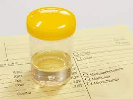 The Clean Catch Urine Sample Method Is A Noninvasive Way To Collect Urine For A Sample While Minimizing The Possibility Of C Urinal Nephrotic Syndrome Cleaning