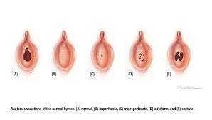 I asked my dad and he said that my mother told the hospital i broke it while bike riding. à¶š à¶š à¶¶à¶± à·ƒ On Twitter Here Is A Picture Of Some Of The Most Frequently Encountered Types Of Thin Hymen Tissue The Normal Hymen Is Porous And Already Broken You Know Why That Because