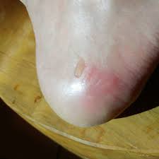 Maybe you would like to learn more about one of these? How To Treat And Prevent A Ski Boot Blister