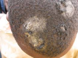 Tinea corporis (ringworm) is a fungal infection of the skin generally characterized (intially) by a red raised round patch, followed by. Ringworm Can Cause Permanent Hair Loss Experts Premium Times Nigeria