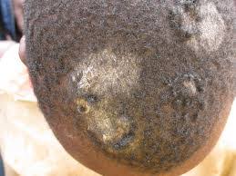 And if does cause pattern hair loss… what can we do about it? Ringworm Can Cause Permanent Hair Loss Experts Premium Times Nigeria