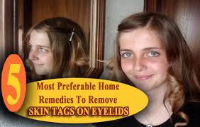 How to remove skin tag on eyelid. 5 Most Preferable Home Remedies To Remove Skin Tags On Eyelids