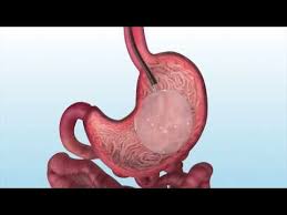 Orbera Balloon Gastric Balloons Orbera Balloon Intragastric Balloon