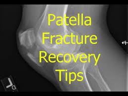 Patella Fracture Recovery Tips Patella Fracture Knee Surgery Recovery Physical Therapy Exercises