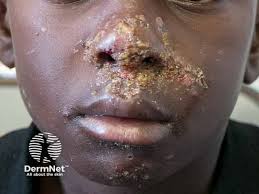 Image result for Impetigo