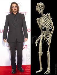 Elephantiasis, also known as lymphatic filariasis, is a very rare condition that's spread by mosquitoes. Johnny Depp Has A Life Size Elephant Man Skeleton Replica In His Office