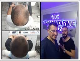 Celal Akfil Sac Golge Merkezi Adli Kullanicinin Sac Golge Merkezi Panosundaki Pin Sac Tibbi Deri