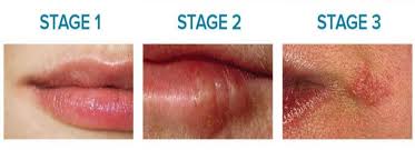 Infection with herpes simplex virus type 1 causes cold sores. Cold Sore Treatment Fever Blisters Coral Springs Dentist