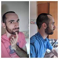 Cut It Yesterday Because I Got Tired Of Trying To Hide My Receding Hairline Should I Have Gone Shorter Bald