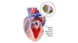 Mitral stenosis is defined as a narrowing of the mitral valve orifice. Mitral Stenosis Iran Health Tourism Organizer Iran Medical Tourism Irhto
