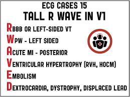 Image result for R Wave