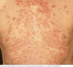 Image result for Pemphigus