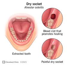 Image result for Tooth Extraction