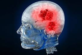 No effective treatment is available. Brain Cancer Causes Types Symptoms Treatment Stages Survival Rate