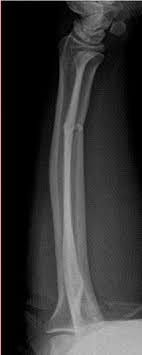 Izole Ulna Saft Kiriklarinin Kisa Kol Sirkuler Alci Ile Tedavisi Pdf Ucretsiz Indirin