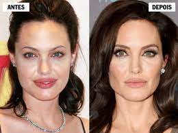 Na cirurgia é retirado o tecido que dá volume às bochechas, a chamada bola ou gordura de bichat. Bichectomia Como Funciona Antes E Depois Preco E Mais