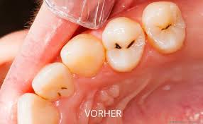 Hochwertige Zahnfullungen Zahnarzt Koln Dr Oliver Kammerer