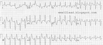 Image result for Right Axis Deviation