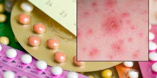 Færrest alvorlige bivirkninger, men individuelle forhold kan få lægen til. Alt Om P Piller Lommelegen