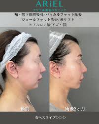 バッカル ファット 40 代