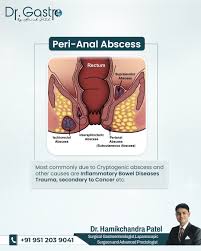 Image result for Ischiorectal Abscess