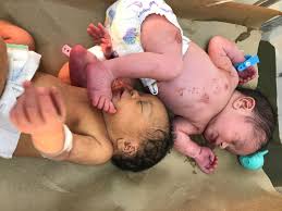 Image result for Kernicterus