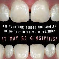 Gingivitis Is An Early Stage Of Gum Disease Zahnarzt Zahngesundheit Zahne