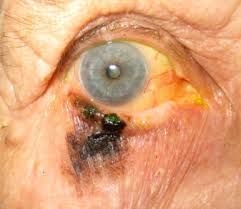 What patients and caregivers need to know about. Melanoma Of The Eyelid And Periocular Skin Histopathologic Classification And Molecular Pathology Sciencedirect