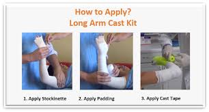 Image result for Long Arm Cast
