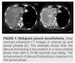 A ct image may show a tumor as a dark mass. Diagnostic Imaging And Workup Of Malignant Pleural Mesothelioma